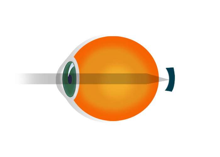 mandale pentru a îmbunătăți vederea lentile de contact pentru miopie