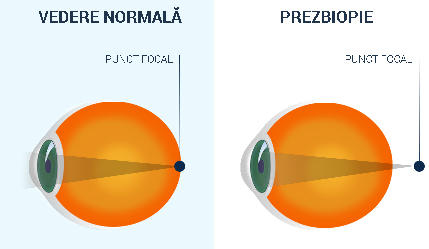 Deficiențe vizuale: Ce este Presbiopia? Cum este tratată? | Blog bufetto.ro