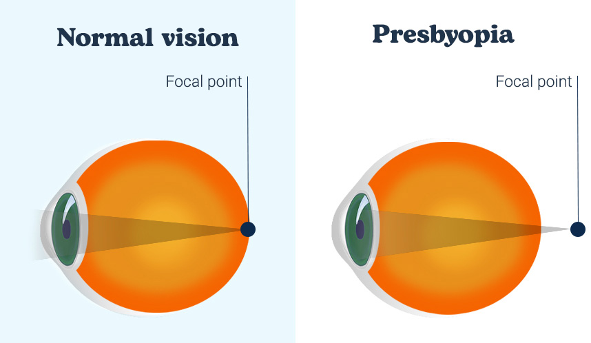 Presbyopia Vuity Eye